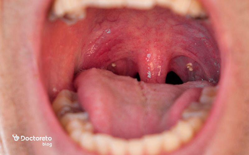 اندازه و شکل سنگ لوزه در عکس چقدر است؟