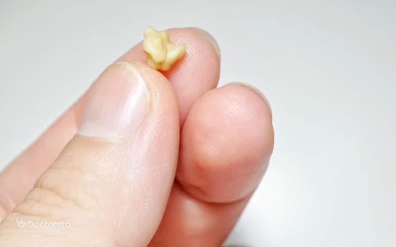 تهوع یا احساس بد به خاطر بو و طعم از عوارض قورت دادن سنگ لوزه است.