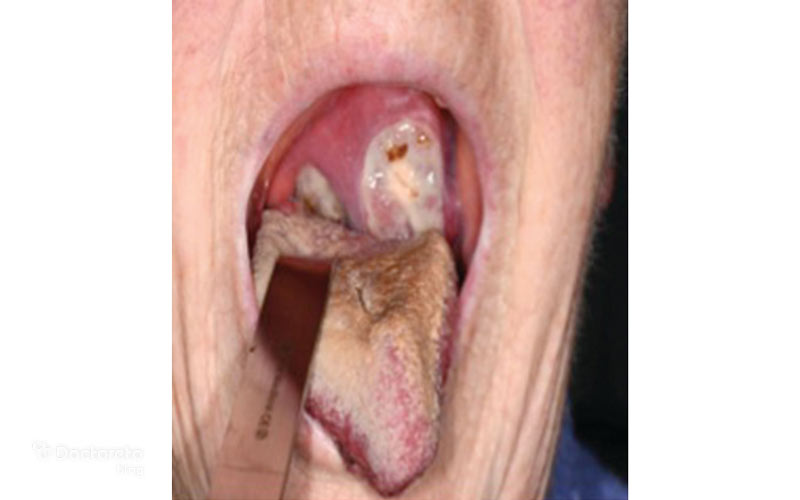 تصاویر سرطان لوزه در مراحل پیشرفته چگونه است؟