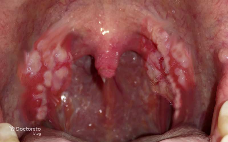 قرمزی لوزهها و گاهی ترشح یا لکههای سفید روی آنها از علائم لوزه ملتهب است.