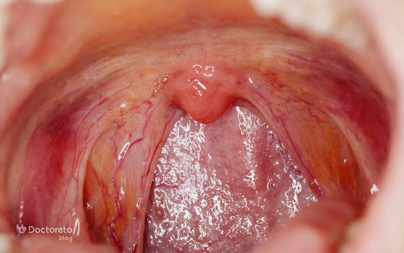 لوزههای سالم معمولاً صورتیرنگ هستند.