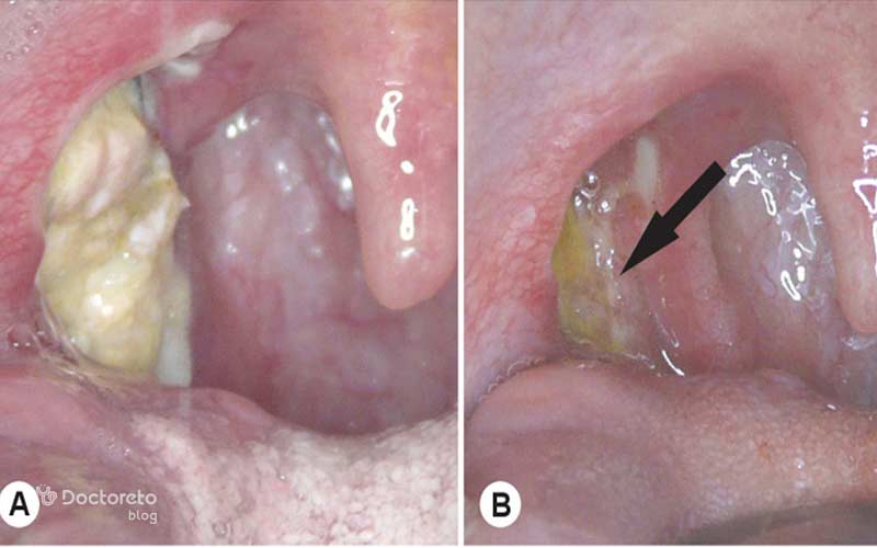 لایه سفید رنگ بعد جراحی لوزه خطرناک نیست.