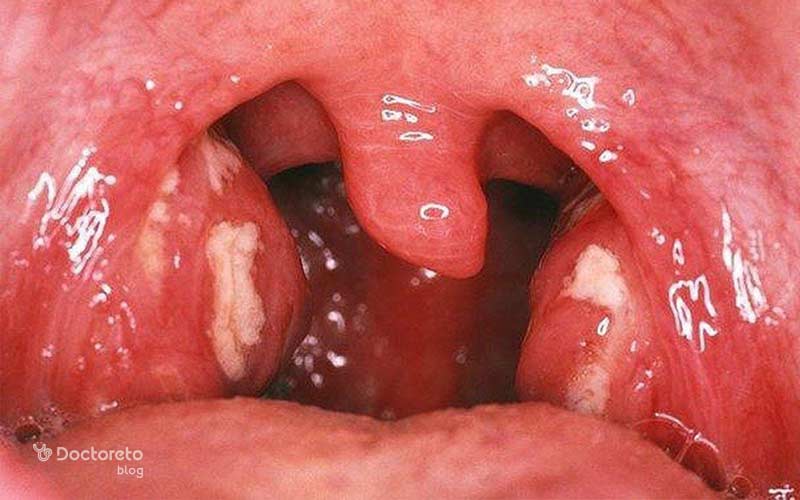 لوزه چرکی معمولاً نتیجه التهاب حاد لوزه است.