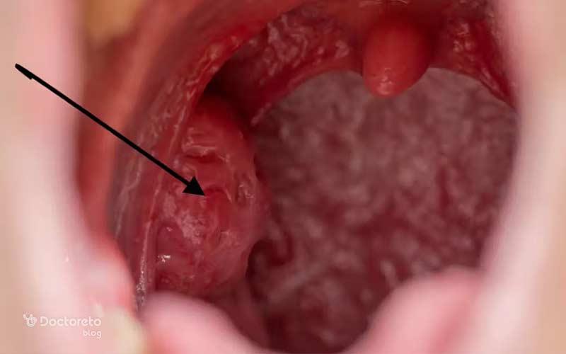 حفره یا کریپت محل تشکیل سنگ هستند.