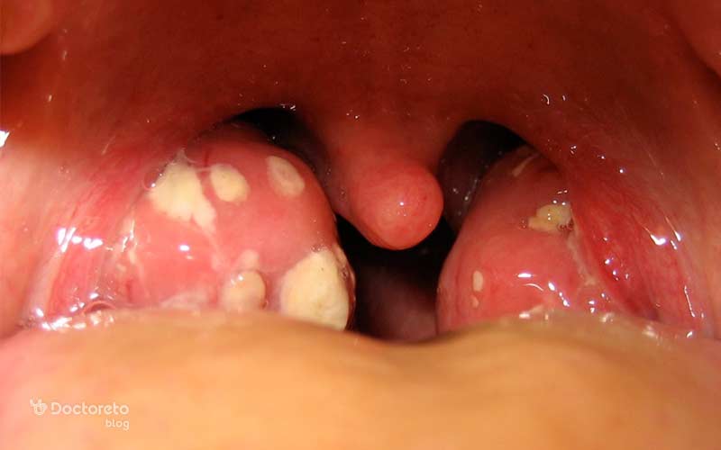 التهاب لوزه، لوزه های کامی را درگیر می کند.