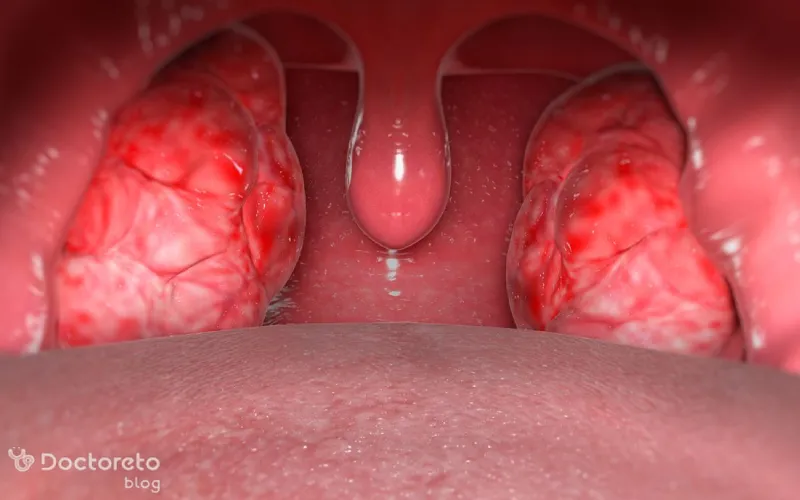 درمان عفونت لوزه شدید و پیچیده در بزرگسالان چگونه است؟