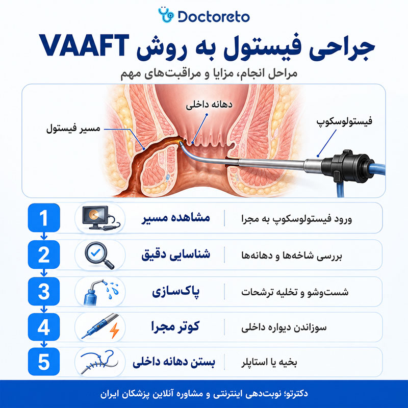 اینفوگرافی جراحی فیستول به روش vaaft