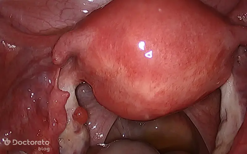 عوارض بستن لوله رحم با لیزر چیست؟