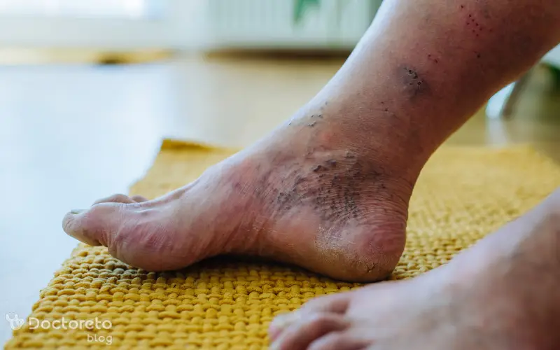 اولین نشانه های شروع زخم پای دیابتی چگونه است؟