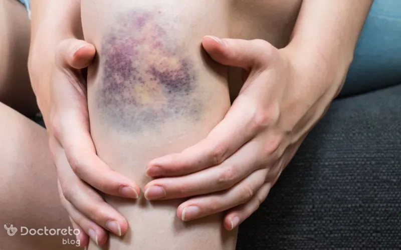 آیا زردچوبه و زرده تخمه مرغ برای ضرب دیدگی موثر است؟