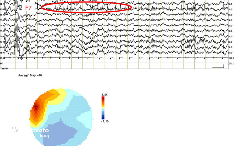 الگوی نوار مغز کودکان اوتیسم چگونه است؟