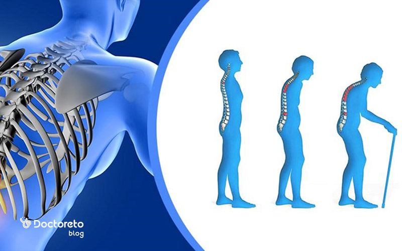 قوز پشت یا کیفوز یکی از علائم پوکی استخوان است.