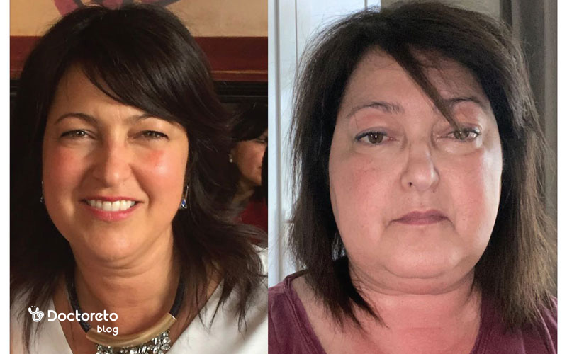 عکس بیماری کوشینگ