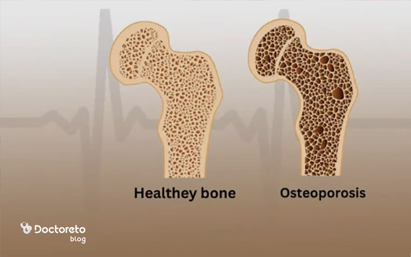 درمان مرحله ای و قطعی در پوکی استخوان شدید چگونه است؟