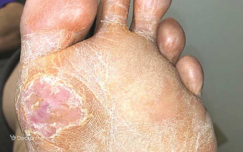 زخم پای دیابتی با ترشح زرد-قهوهای (pus) و حاشیههای عفونی دیده میشود.