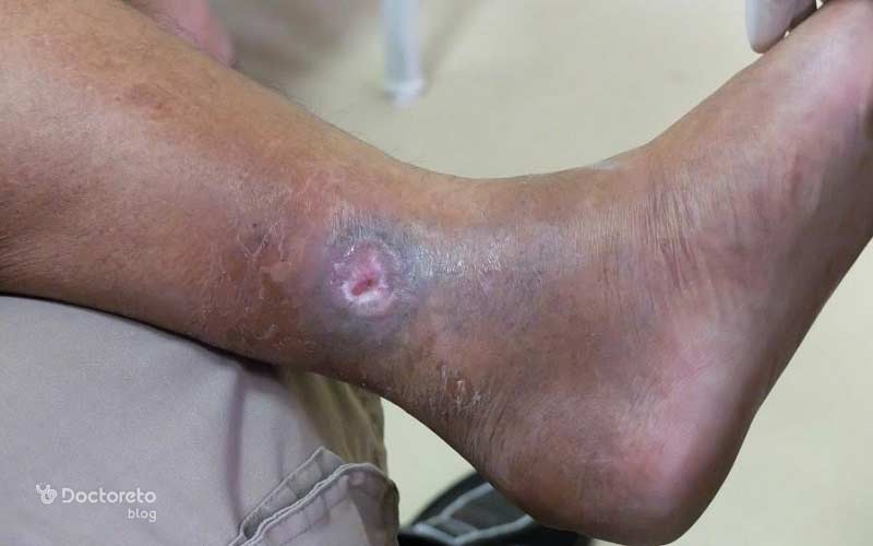 زخم بعد از دبریدمان با بافت تمیز و آماده برای مراحل بعدی درمان است.