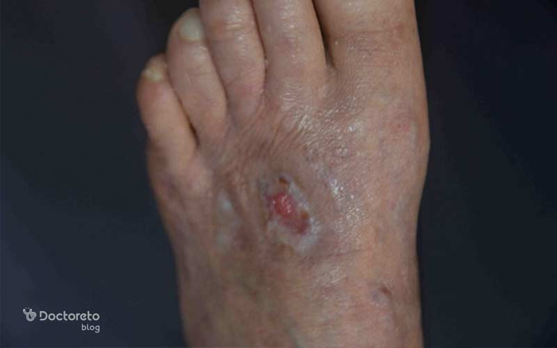 ظاهر زخم دیابتی بعد از فرآیند پانسمانی بدین شکل است.