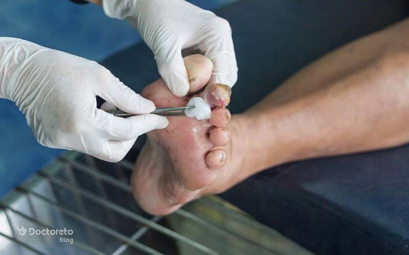 نحوه پانسمان زخم دیابتی این گونه است.