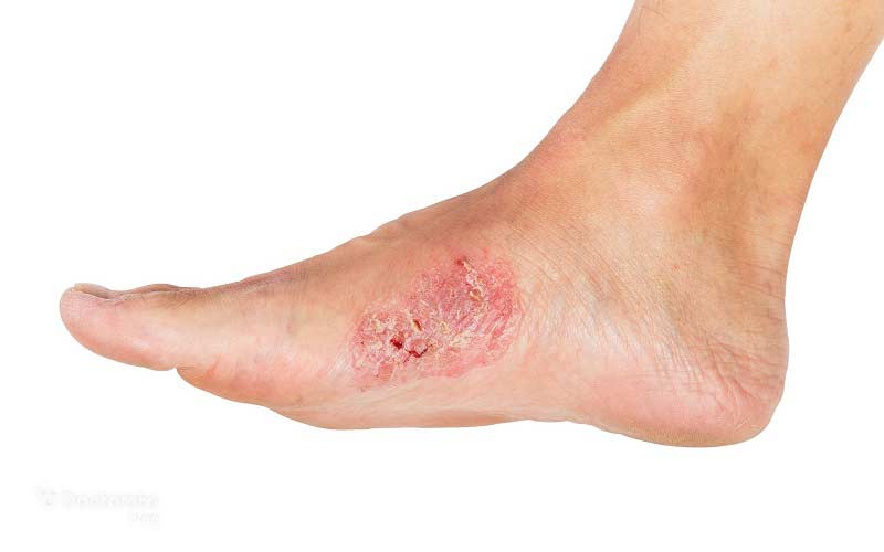 مناطق تحت فشار در پای دیابتیها میتواند باعث ایجاد زخم شود.