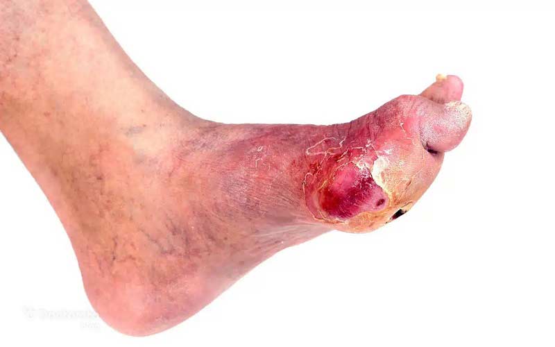 زخم عفونی پای دیابتی با ترشح چرکی زرد-قرمز و اطراف متورم و قرمز دیده میشود.