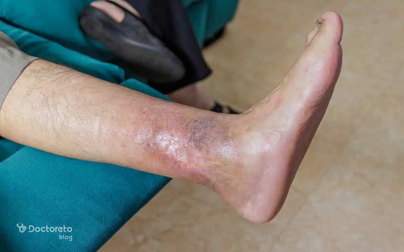 زخم سطحی پای دیابتی بدین شکل است.