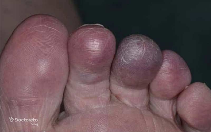 پای دیابتی با گانگرن سیاه در انگشتان، بافت خشک و سیاهرنگ با حاشیههای مشخص دیده میشود.