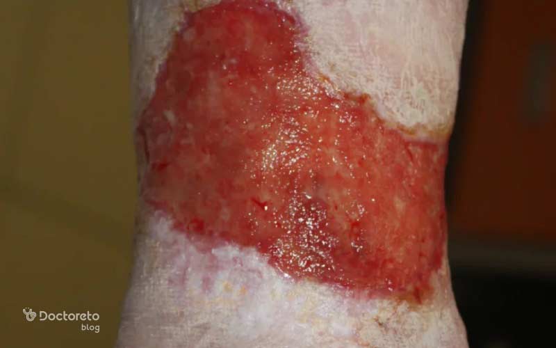 زخم پای دیابتی ممکن است دچار عفونت شود.