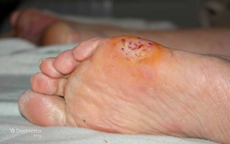 نمای نزدیک از زخم پای دیابتی که از میخچه یا تاول شروع شده است.