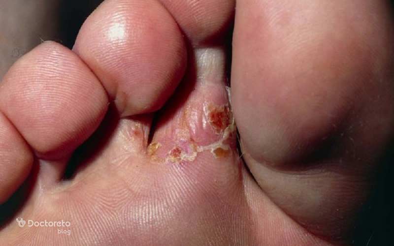 در بیماران دیابتی ضایعه مربوط به میخچه میتواند به زخم تبدیل شود.