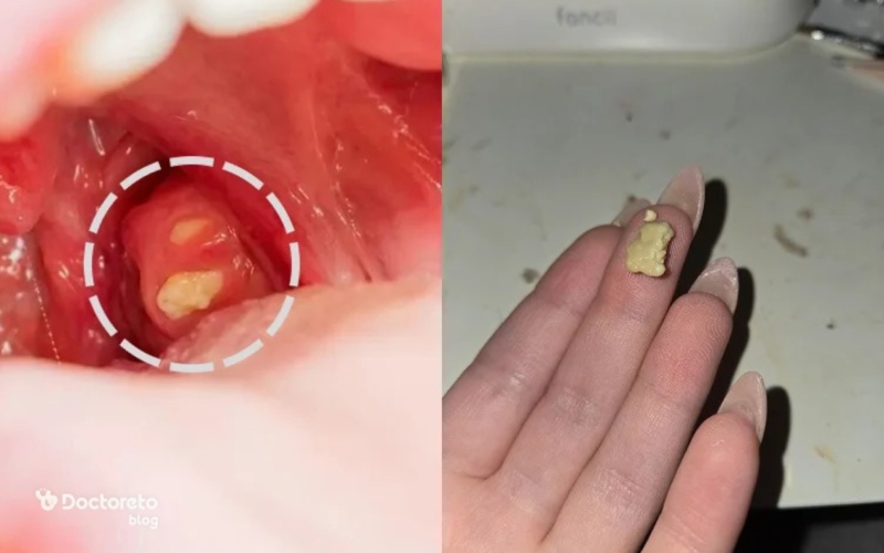 عکس قبل و بعد از خارج کردن سنگ لوزه