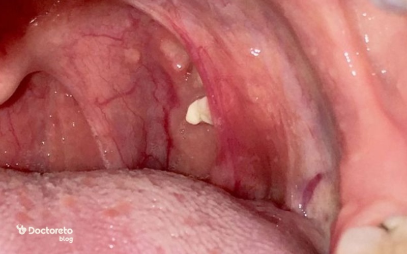 عکس سنگ لوزه در دهان از نمای نزدیک