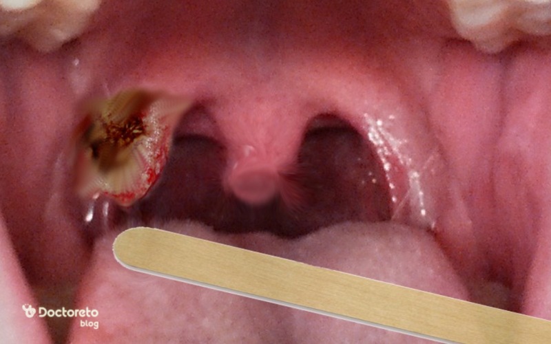 تصاویر سرطان لوزه در مراحل پیشرفته