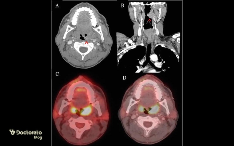 تصویربرداری از سرطان لوزه