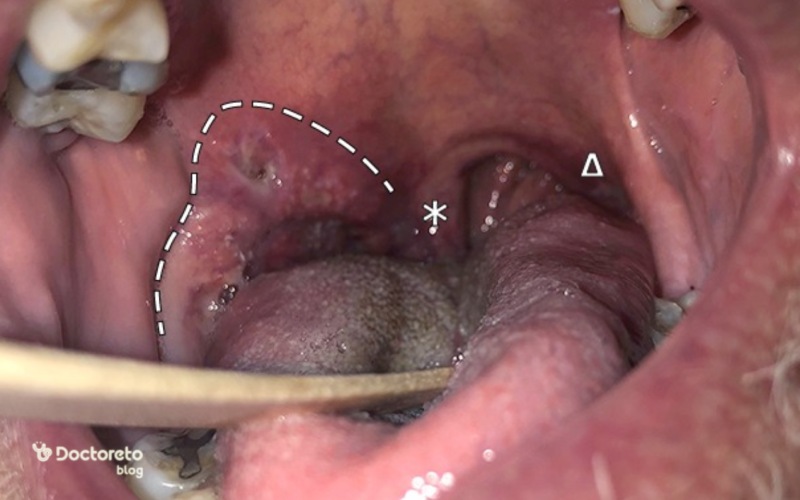 عکس تفاوت سنگ لوزه و سرطان لوزه
