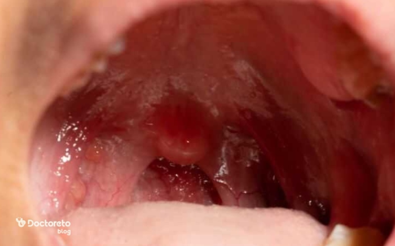 عکس سرطان لوزه در مراحل اولیه چگونه است؟