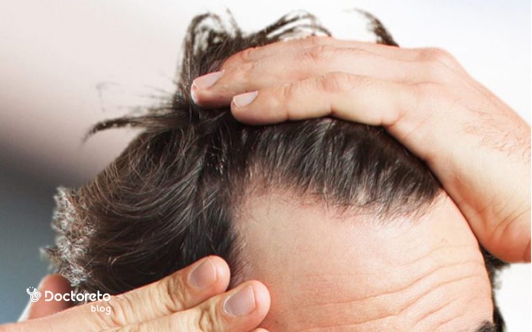 بهترین روش درمان ریزش مو در مردان کدام است؟