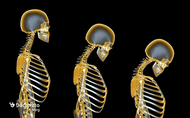 علائم مخفی پوکی استخوان در ستون فقرات چگونه خود را نشان می دهد؟