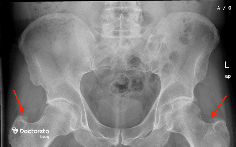 عکس پوکی استخوان لگن و ران