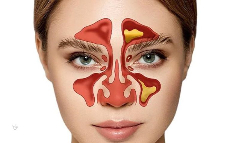 بهترین آنتی بیوتیک برای سینوزیت کدام است؟