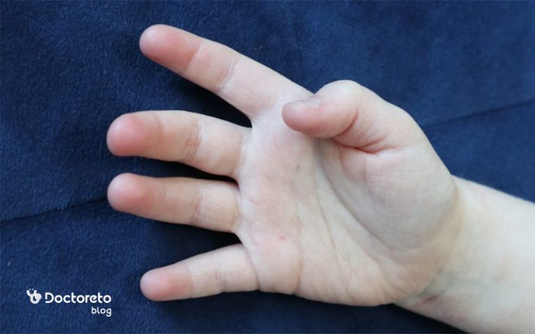 انگشت ماشه ای در کودکان به چه علت رخ میدهد؟