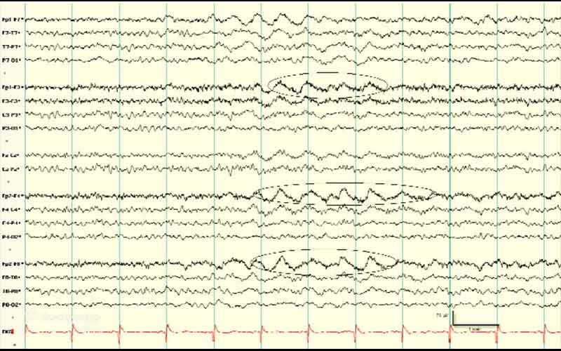 خطهای موجی غیر یکنواخت، امواج نامرتب، و تغییرات فرکانسی از EEG نرمال متمایز هستند.