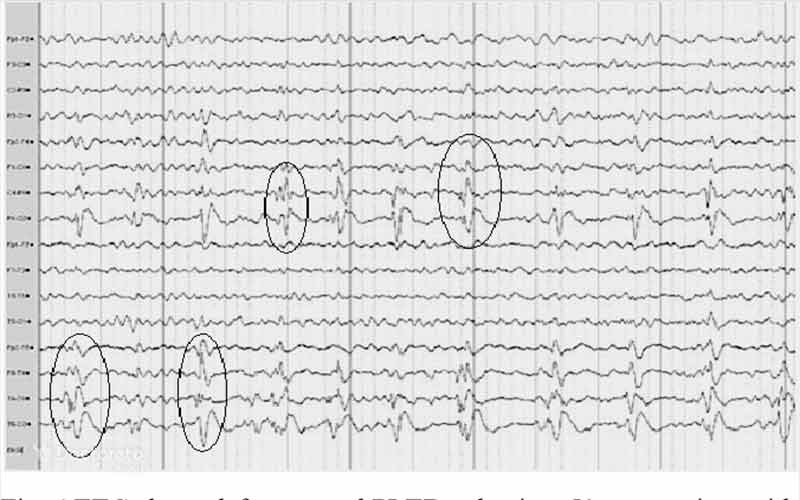 الگوهای EEG غیرطبیعی میتوانند در بیماران با آسیب مغزی، تومور یا سایر ناهنجاریها دیده شوند.