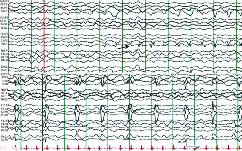 تغییر در ریتم و دامنه امواج نسبت به حالت سالم کاملاً مشهود است.