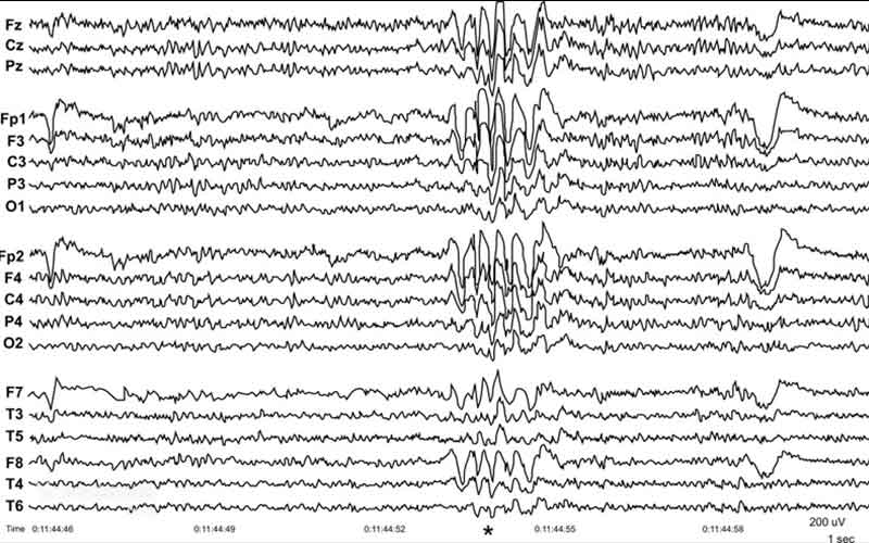 امواج تیز و نامنظم نشاندهنده اختلال در الگوی طبیعی امواج مغزی است.