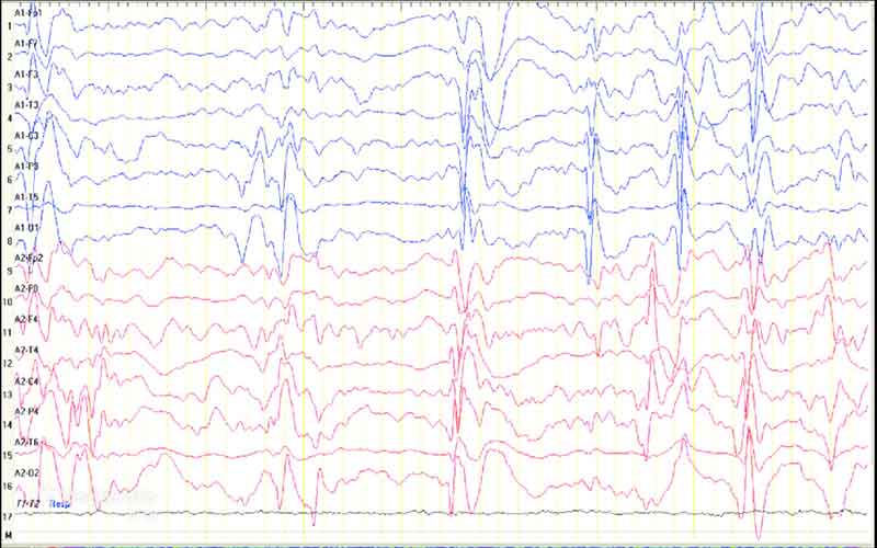 این نوع EEG معمولاً در عفونتهای مغزی یا التهاب مغز (انسفالوپاتی) دیده میشود و با کندی منتشر امواج، از بین رفتن ریتم معمول و الگوهای آشفته همراه است.