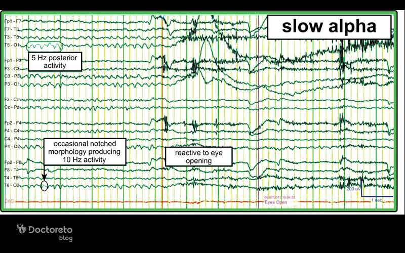 EEG با کندی عمومی و امواج غیر طبیعی که میتواند در التهاب مغزی یا اختلالات شدید عملکردی دیده شود.