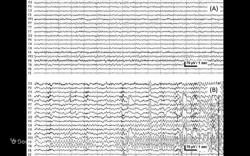 این تصویر نشان میدهد که الگوی نوار مغزی غیرطبیعی یا حین تشنج از EEG طبیعی متفاوت است.