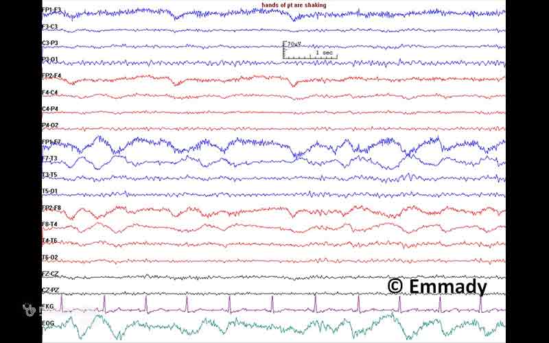 الگوهای غیرطبیعی نوار مغزی میتواند نشاندهندهی اختلالات ساختاری مثل سکته یا تومور باشد.