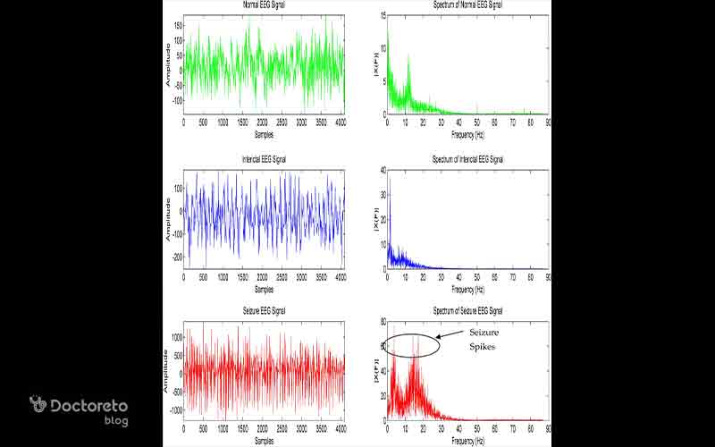 نوار مغزی در هنگام تشنج اغلب با امواج نامنظم، spikes و ریتمهای بلندتر مشخص میشود.