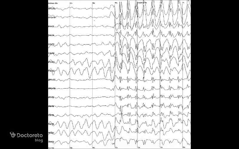 سیگنالهای مغزی در هنگام تشنج دچار تغییر میشود.